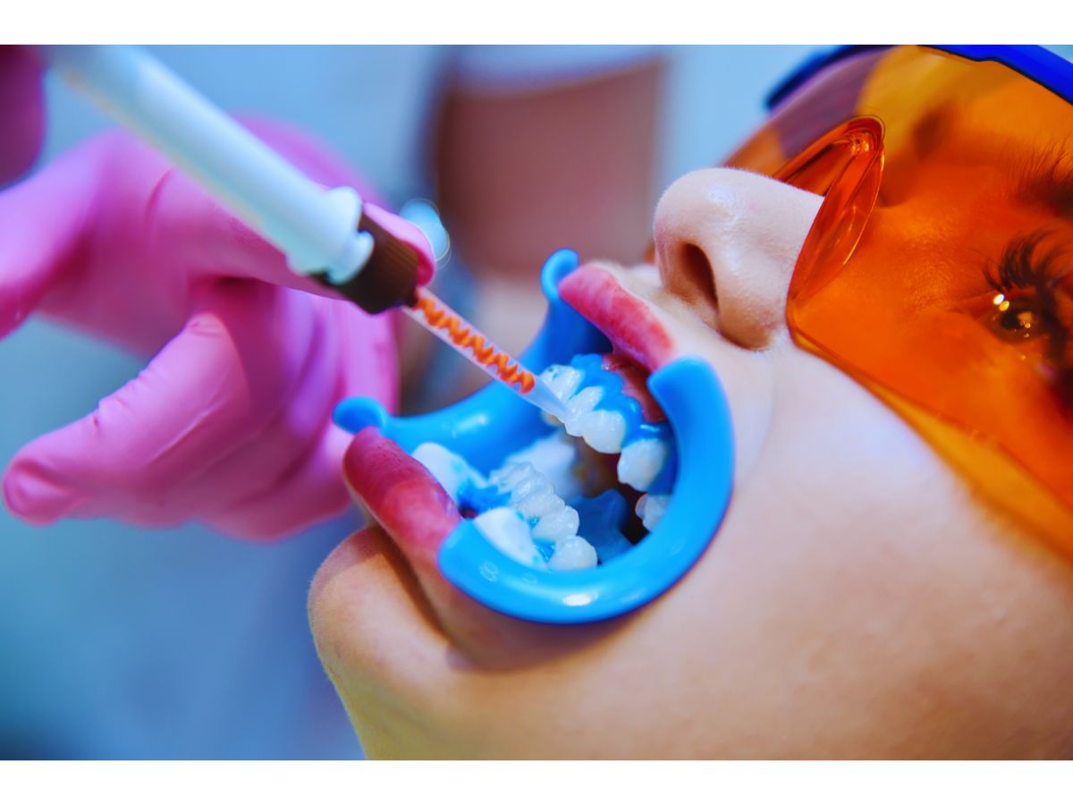 تبييض الأسنان