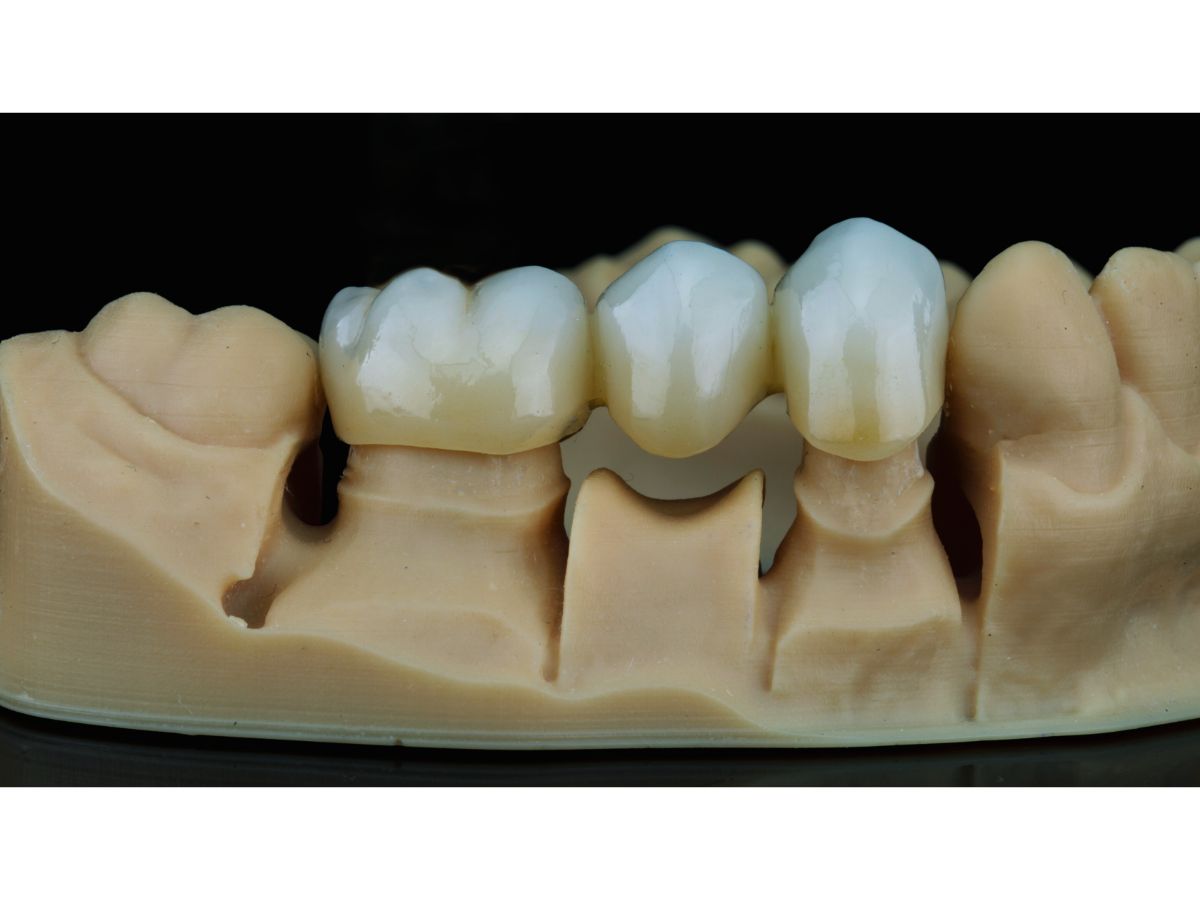 تيجان بورسلين