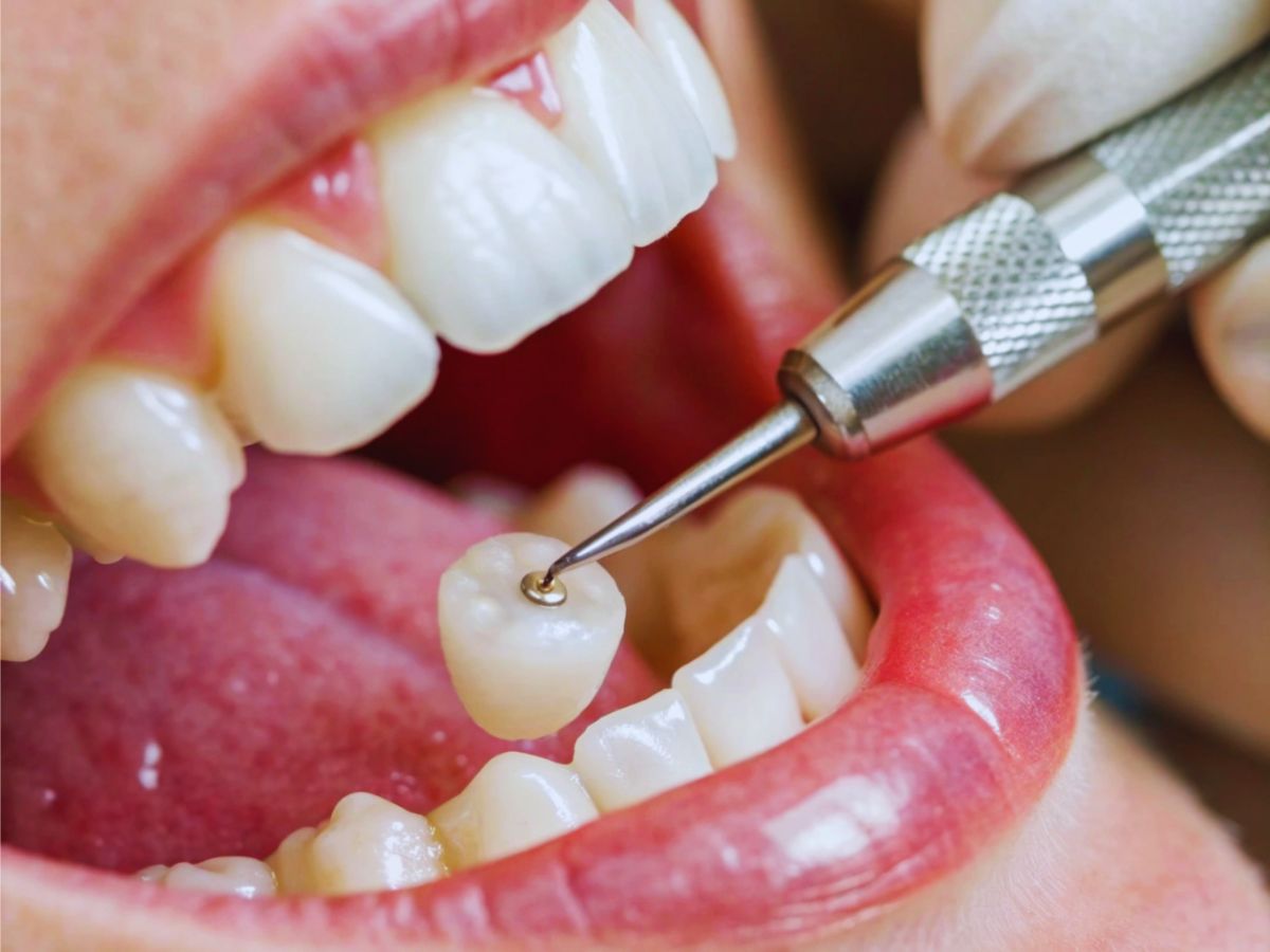 تيجان زيركون